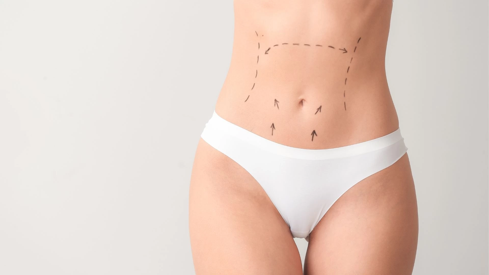 Abdominoplastie