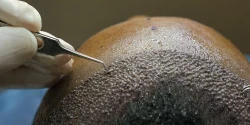 Afro Hair Transplant