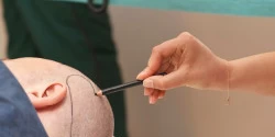 Fue Hair Transplantation